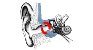 Entstehungsbereich der Verknöcherung des Gehörganges beim surfers ear