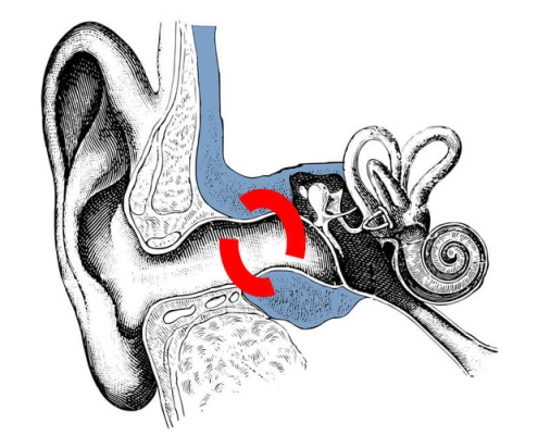 Surfer Ohr, Surfer’s ear Phenomen, oder auch diffuse Exostose 13 Entstehungsbereich der Verknöcherung des Gehörganges beim surfers ear