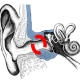 Entstehungsbereich der Verknöcherung des Gehörganges beim surfers ear